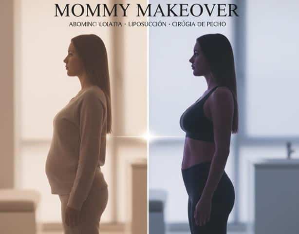 Qué es el Mommy Makeover, requisitos, beneficios y cuidados